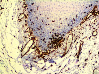IHC of Vimentin on an FFPE Cervix Tissue